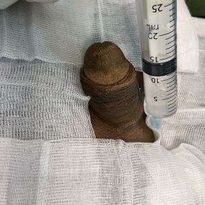 Động dương vật bằng mô da nhân tạo, đường mổ ở mu, khách hàng 43 tuổi, Lào Cai - ca 123