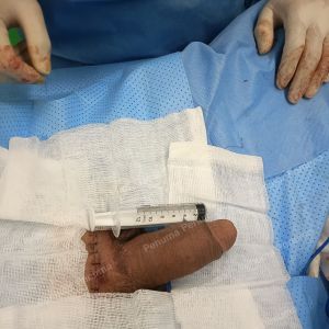 Độn dương vật bằng mô da nhân tạo, đường mổ ở mu, khách hàng 38 tuổi Bình Dương - ca 102