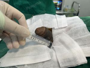 Độn dương vật bằng mô da nhân tạo, đường mổ ở mu, khách hàng 42 tuổi Ninh Bình - ca 110