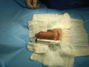 Tăng kích thước dương vật bằng mô da nhân tạo, đường mổ ở mu, khách hàng 30 tuổi An Giang - ca 111