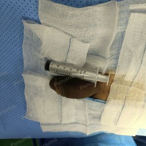 Tăng kích thước dương vật bằng mô da nhân tạo, đường mổ ở mu, khách hàng 46 tuổi Nha Trang - ca 91