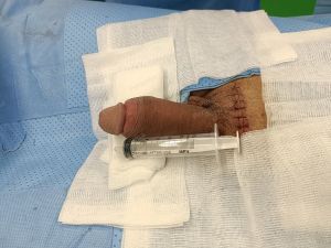 Độn dương vật bằng mô da nhân tạo, đường mổ ở mu, khách hàng 36 tuổi, HCM -  ca 121