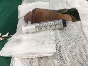 Tăng kích thước cậu nhỏ bằng tấm độn megaderm, đường mổ ở mu, khách hàng 35 tuổi, Hà Nội -  ca 118