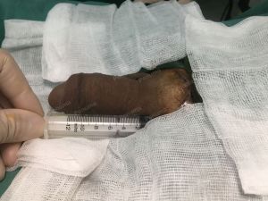 Tăng kích thước bằng mô da nhân tạo, đường mổ ở mu, khách hàng 35 tuổi Hà Nội - ca 109