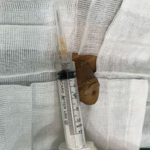 Tăng kích thước cậu nhỏ bằng tấm độn sinh học, đường mổ ở mu, khách hàng 42 tuổi, Thanh Hóa -  ca 120