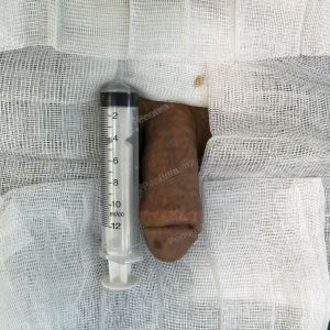 Tăng kích thước cậu nhỏ bằng tấm độn sinh học, đường mổ ở mu, khách hàng 42 tuổi, Thanh Hóa -  ca 120