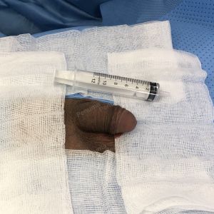 Tăng kích thước dương vật bằng mô da nhân tạo, đường mổ ở mu, khách hàng 30 tuổi An Giang - ca 111