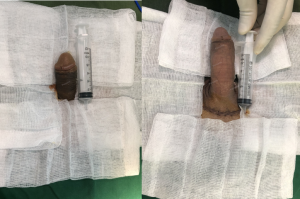 Tăng kích thước dương vật bằng mô da nhân tạo, đường mổ ở mu, khách hàng 38 tuổi Hà Nội- ca 89