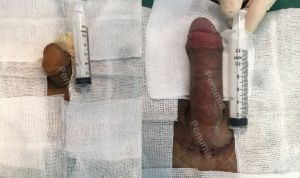 Độn dương vật bằng mô da nhân tạo, đường mổ ở mu, khách hàng 34 tuổi Hà Nội - ca 92