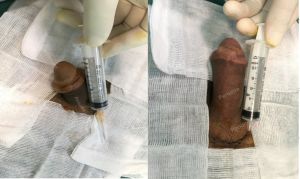 Tăng kích thước dương vật bằng mô da nhân tạo, đường mổ ở mu, khách hàng 38 tuổi Lào Cai - ca 93