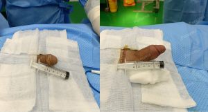 Độn dương vật bằng mô da nhân tạo, đường mổ ở mu, khách hàng 33 tuổi Đồng Nai - ca 94