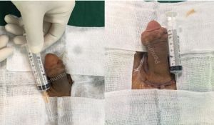 Độn dương vật bằng mô da nhân tạo, đường mổ ở mu, khách hàng 40 tuổi Hải phòng - ca 90