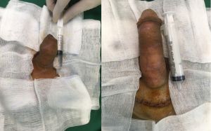 Độn dương vật bằng mô da nhân tạo, đường mổ ở mu, khách hàng 35 tuổi Quảng Ninh - ca 100