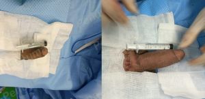 Độn dương vật bằng mô da nhân tạo, đường mổ ở mu, khách hàng 38 tuổi Bình Dương - ca 102