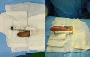 Độn dương vật bằng mô da nhân tạo, đường mổ ở mu, khách hàng 33 tuổi Bình Phước - ca 104