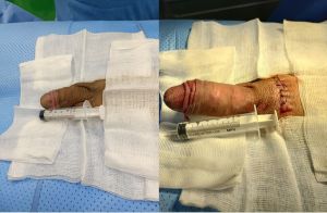 Tăng kích thước dương vật bằng mô da nhân tạo, đường mổ ở mu, khách hàng 30 tuổi Phú Quốc - ca 105