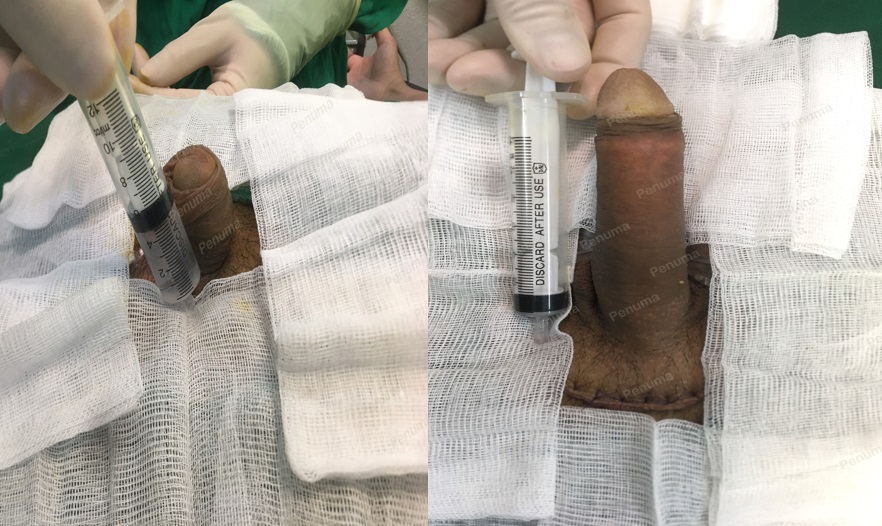 Độn dương vật bằng mô da nhân tạo, đường mổ ở mu, khách hàng 29 tuổi Hà Nội - ca 106