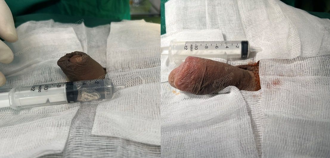 Tăng kích thước cậu nhỏ bằng tấm độn sinh học megaderm , đường mổ ở mu, khách hàng 41 tuổi, Thanh Hóa - ca 122