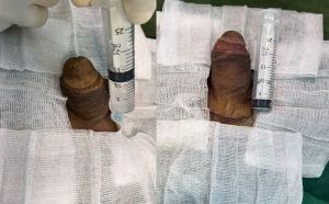 Động dương vật bằng mô da nhân tạo, đường mổ ở mu, khách hàng 43 tuổi, Lào Cai - ca 123