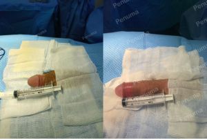 Độn dương vật bằng mô da nhân tạo, đường mổ ở mu, khách hàng 38 tuổi Đồng Nai - ca 88