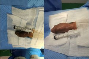 Tăng kích thước dương vật bằng mô da nhân tạo, đường mổ ở mu, khách hàng 46 tuổi Nha Trang - ca 91