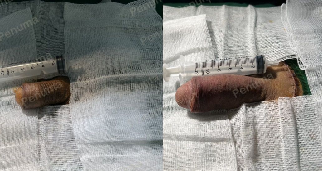 Độn dương vật bằng tấm độn megaderm, đường mổ ở mu, khách hàng 38 tuổi Hà Nội - ca 115