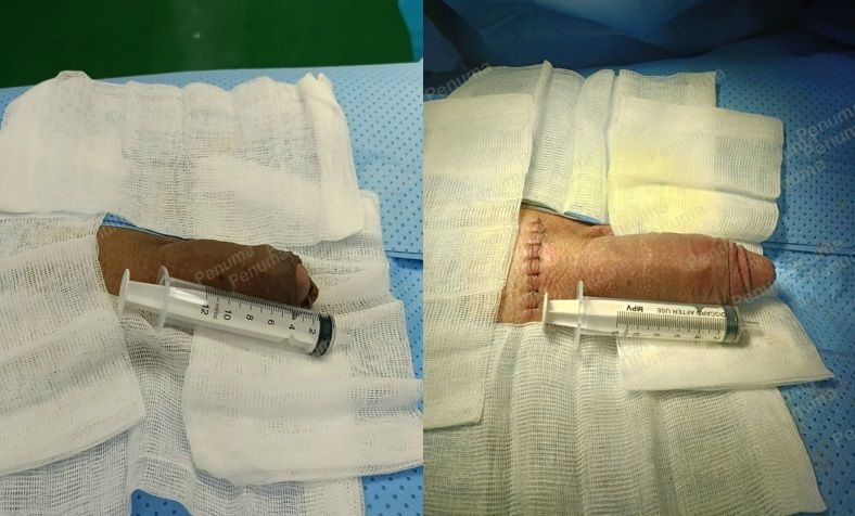 Độn dương vật bằng tấm độn sinh học, đường mổ ở mu, khách hàng 38  tuổi HCM - ca 117