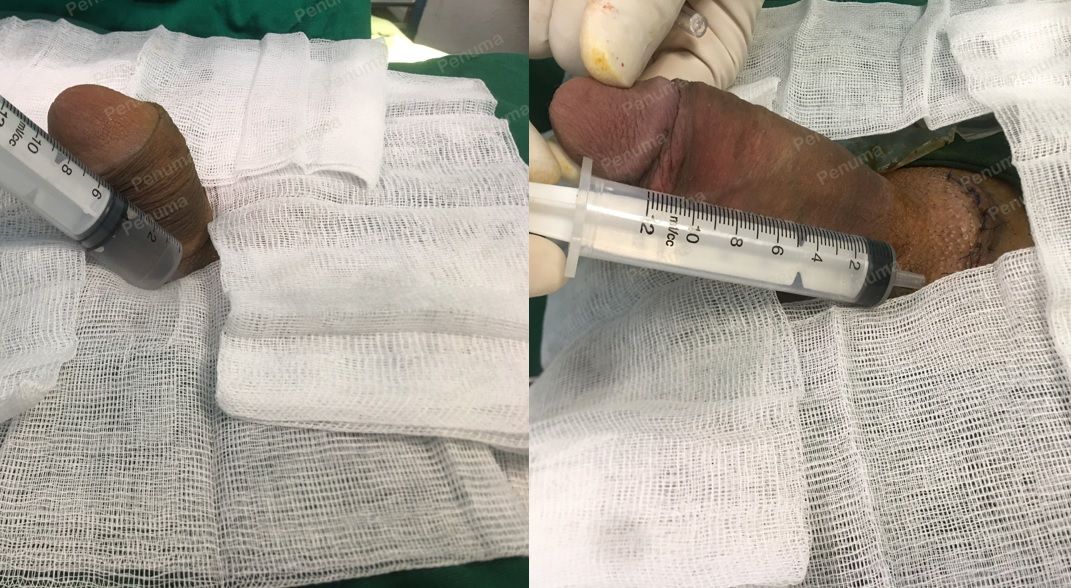 Tăng kích thước cậu nhỏ bằng tấm độn megaderm, đường mổ ở mu, khách hàng 35 tuổi, Hà Nội -  ca 118