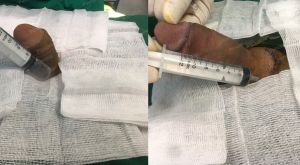 Tăng kích thước cậu nhỏ bằng tấm độn megaderm, đường mổ ở mu, khách hàng 35 tuổi, Hà Nội -  ca 118