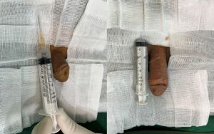 Tăng kích thước cậu nhỏ bằng tấm độn sinh học, đường mổ ở mu, khách hàng 42 tuổi, Thanh Hóa -  ca 120