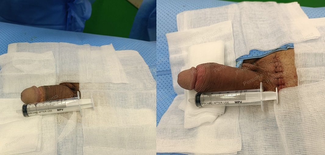 Độn dương vật bằng mô da nhân tạo, đường mổ ở mu, khách hàng 36 tuổi, HCM -  ca 121