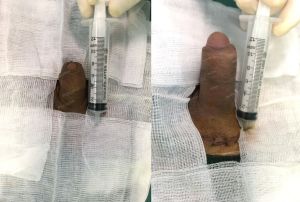 Độn dương vật bằng mô da nhân tạo, đường mổ ở mu, khách hàng 38 tuổi Thái Bình - ca 108