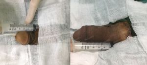 Tăng kích thước bằng mô da nhân tạo, đường mổ ở mu, khách hàng 35 tuổi Hà Nội - ca 109