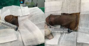 Độn dương vật bằng mô da nhân tạo, đường mổ ở mu, khách hàng 42 tuổi Ninh Bình - ca 110