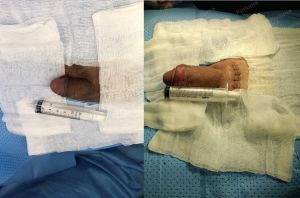 Tăng kích thước dương vật bằng mô da nhân tạo, đường mổ ở mu, khách hàng 30 tuổi An Giang - ca 111