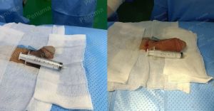 Tăng kích thước dương vật bằng tấm độn sinh học, đường mổ ở mu, khách hàng 33 tuổi HCM - ca 113