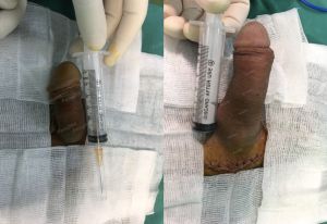 Độn dương vật bằng tấm độn megaderm, đường mổ ở mu, khách hàng 33 tuổi Hà Nội - ca 114