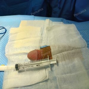 Độn dương vật bằng mô da nhân tạo, đường mổ ở mu, khách hàng 38 tuổi Đồng Nai - ca 88