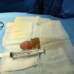 Độn dương vật bằng mô da nhân tạo, đường mổ ở mu, khách hàng 38 tuổi Đồng Nai - ca 88