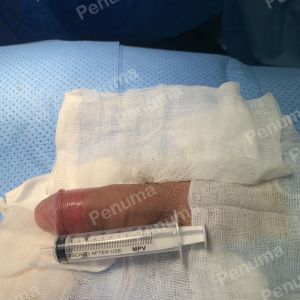 Độn dương vật bằng mô da nhân tạo, đường mổ ở mu, khách hàng 38 tuổi Đồng Nai - ca 88