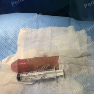 Độn dương vật bằng mô da nhân tạo, đường mổ ở mu, khách hàng 38 tuổi Đồng Nai - ca 88