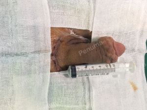 Độn dương vật bằng mô da nhân tạo, đường mổ ở mu, khách hàng 40 tuổi Hải phòng - ca 90