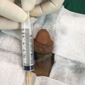 Độn dương vật bằng mô da nhân tạo, đường mổ ở mu, khách hàng 40 tuổi Hải phòng - ca 90