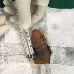 Độn dương vật bằng mô da nhân tạo, đường mổ ở mu, khách hàng 40 tuổi Hải phòng - ca 90