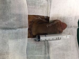 Độn dương vật bằng mô da nhân tạo, đường mổ ở mu, khách hàng 40 tuổi Hải phòng - ca 90