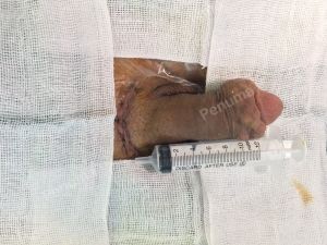 Độn dương vật bằng mô da nhân tạo, đường mổ ở mu, khách hàng 40 tuổi Hải phòng - ca 90