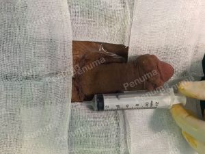 Độn dương vật bằng mô da nhân tạo, đường mổ ở mu, khách hàng 40 tuổi Hải phòng - ca 90