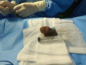 Tăng kích thước dương vật bằng mô da nhân tạo, đường mổ ở mu, khách hàng 30 tuổi HCM - ca 95