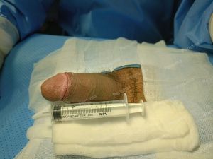 Tăng kích thước dương vật bằng mô da nhân tạo, đường mổ ở mu, khách hàng 30 tuổi HCM - ca 95