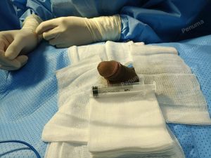 Tăng kích thước dương vật bằng mô da nhân tạo, đường mổ ở mu, khách hàng 30 tuổi HCM - ca 95